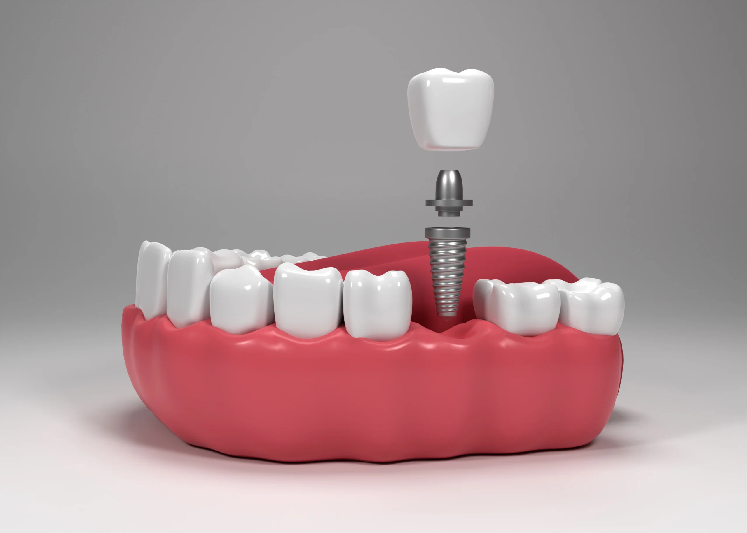 Hollywood Smile