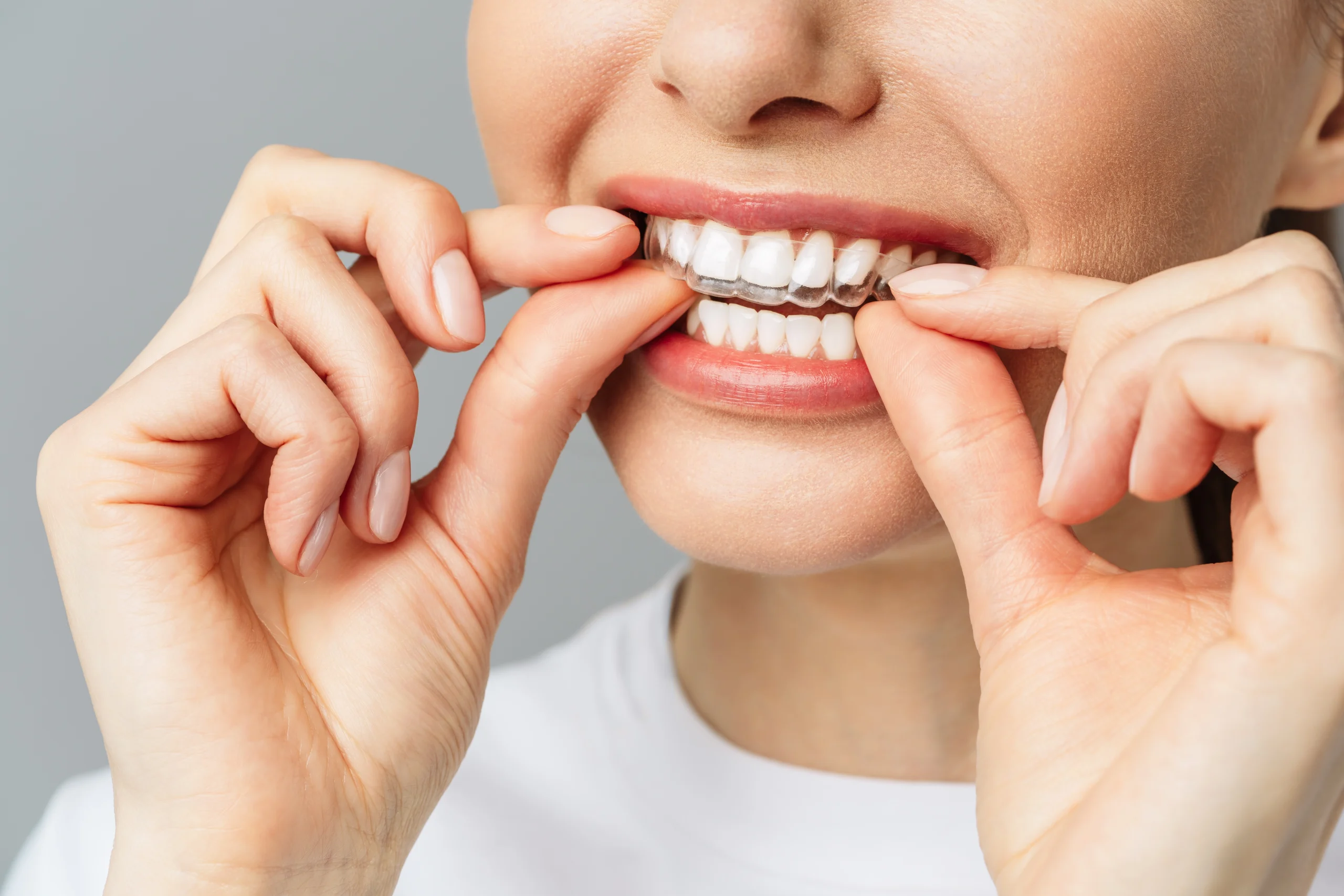 Hollywood Smile